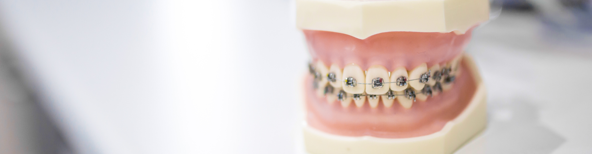 Close-up of a dental model fitted with traditional metal braces, demonstrating how braces align teeth during orthodontic treatment.